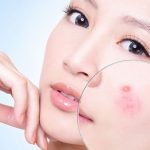 Top 10 Kem Trị Mụn Gel Trị Mụn