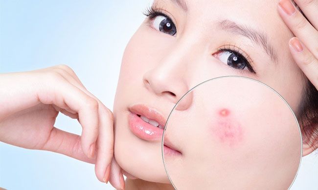Top 10 Kem Trị Mụn Gel Trị Mụn