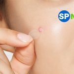 Top 10 Miếng Dán Trị Mụn được ưa chuộng trong năm